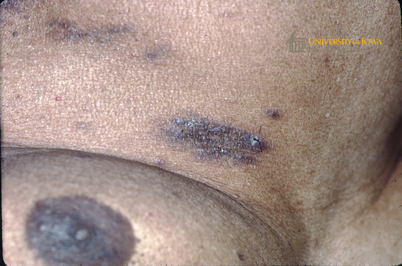 Hyperpigmented papules coalescing into a plaque on the abdomen. (click images for higher resolution).